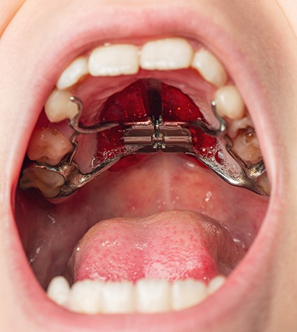 Child with a palatal expander