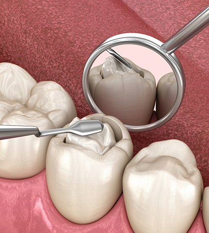 Illustration of dental instruments accessing the innermost layer of a tooth